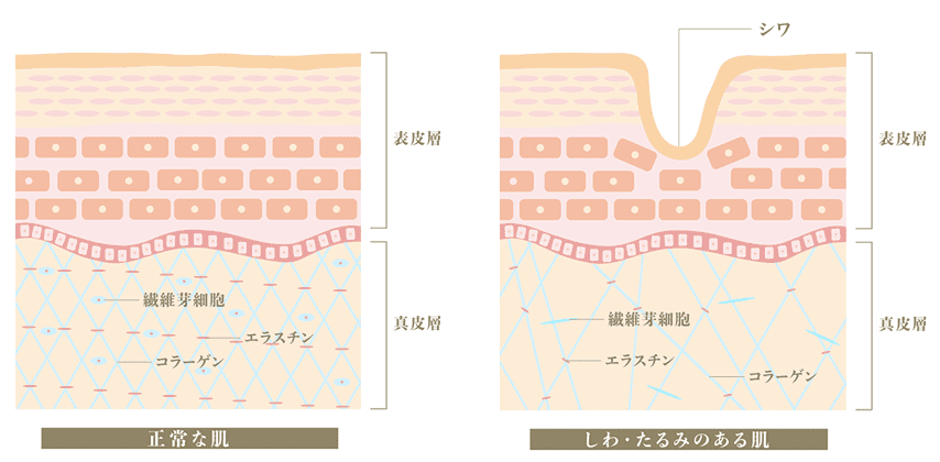 正常な肌としわ・たるみのある肌の比較