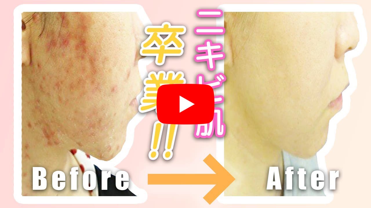 【ニキビ治療 ケミカルピーリング 】男性4割! 誰もが憧れる美肌へ劇的チェンジ!!